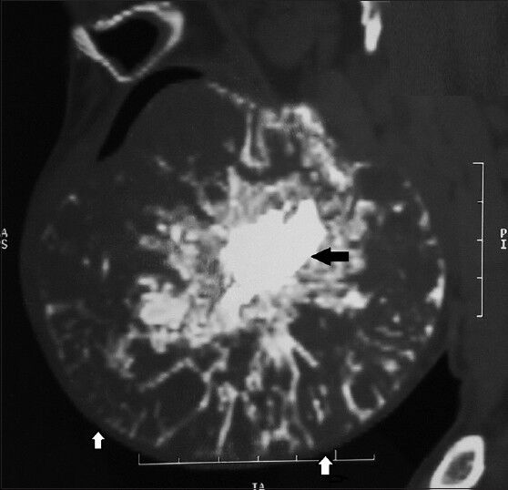 38-year-old female patient with a huge swelling on the right side of the face diagnosed with calcifying epithelial odontogenic tumor. Sagittal view computed tomography scan reveals a well-defined heterodense tumor mass with an irregular central hyperdense mass (black arrow) and expanded inferior border (white arrow) of the mandible without any perforation.